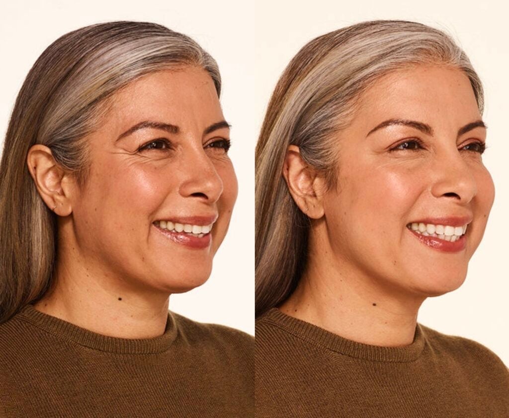 botox refresh Before After Crows Feet