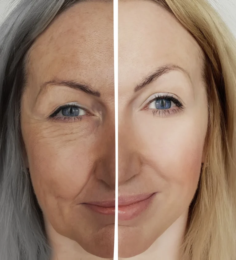 Ozempic Face before after chillicothe ohio fillers botox