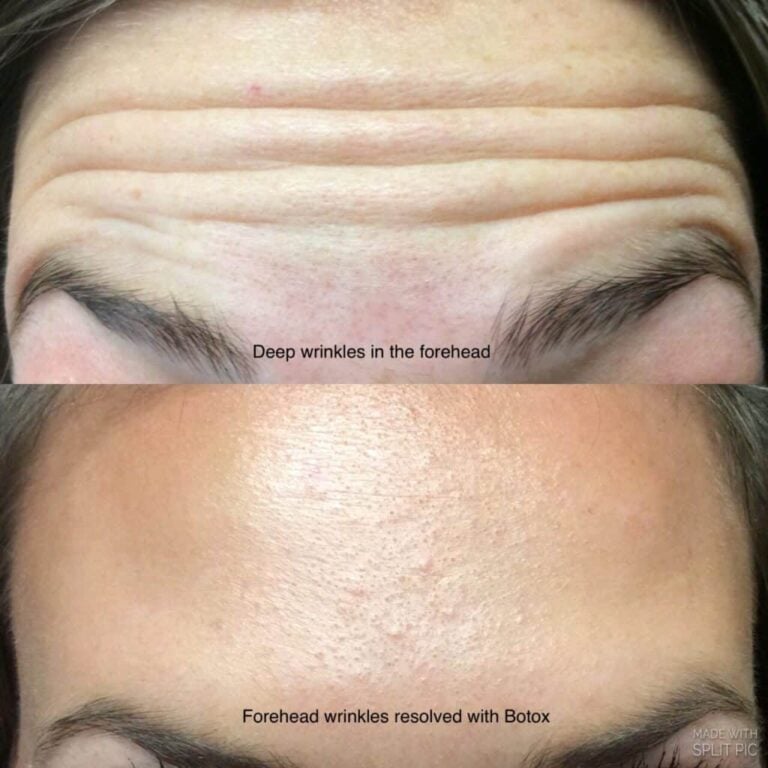 botox Chillicothe Ohio before after (1)