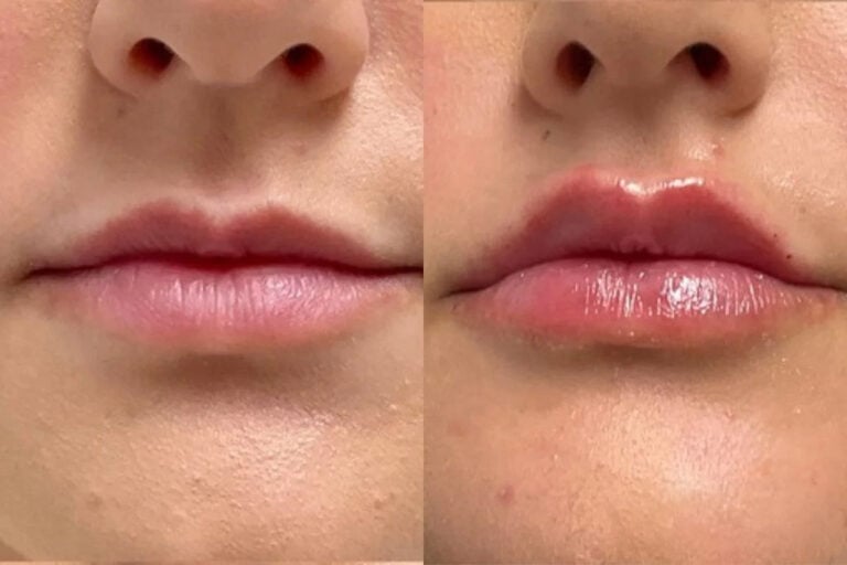 chillicothe ohio lip filler (2)