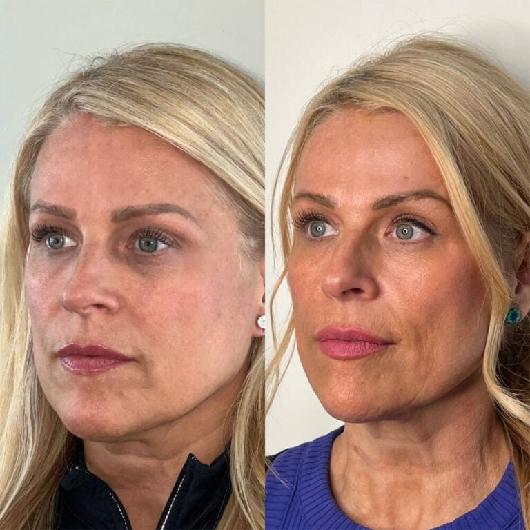 dermal fillers Chillicothe Ohio before after (4)