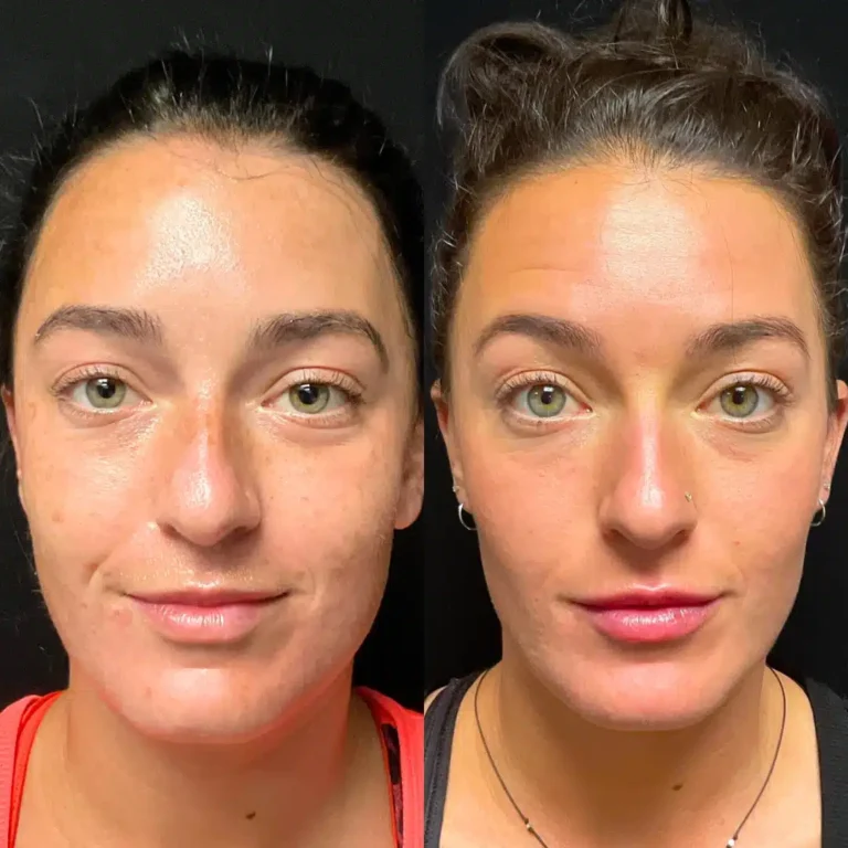 microneedling chillicothe ohio (2)