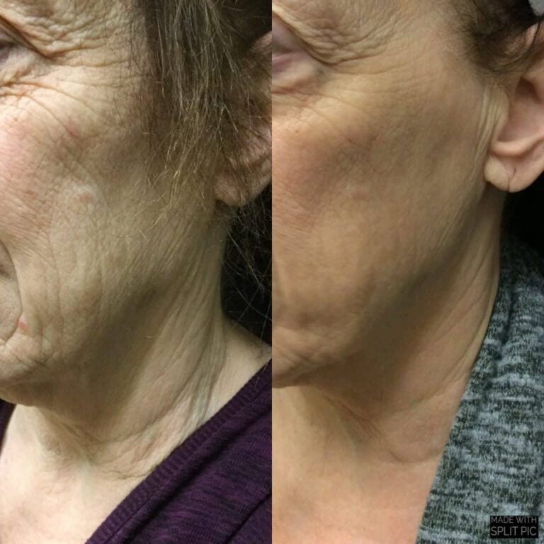 microneedling woman 1024x1024