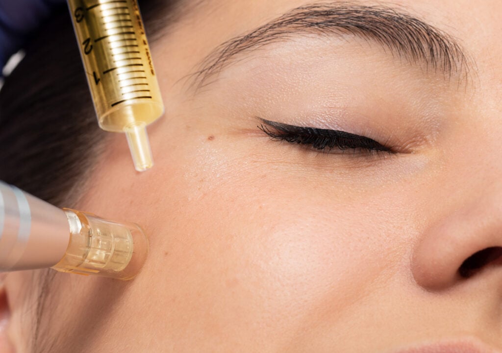prp microneedling